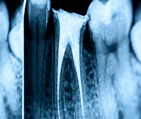 Endodontic Treatment