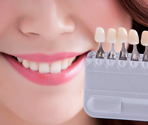 Teeth Whitening & Bleaching Service