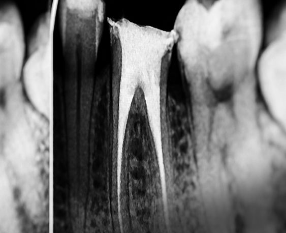 Endodontic Treatment in Oakville