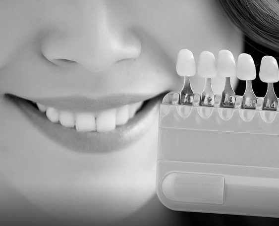 Teeth Whitening & Bleaching Services in Oakville
