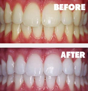 Teeth Bleaching