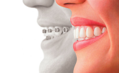 See the difference with Invisalign. (Source: Wikimedia Commons)