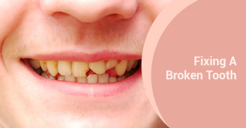 Fixing A Broken Tooth
