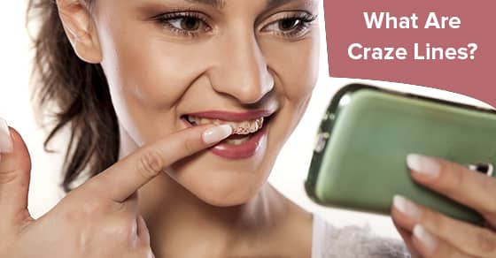 What Are Craze Lines?  Oakville Place Dental