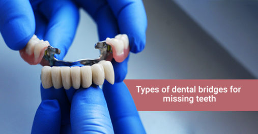 Types of dental bridges for missing teeth