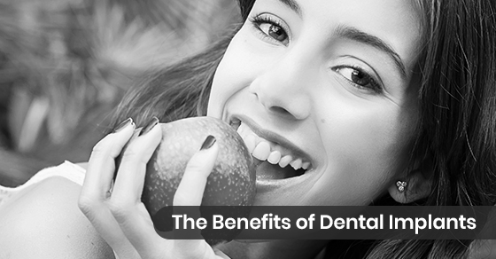 Benefits of Dental Implants