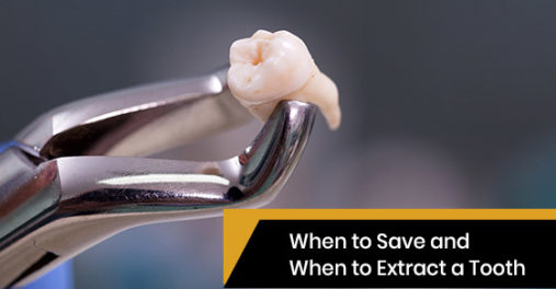 When to Save and When to Extract a Tooth | Oakville Place Dental