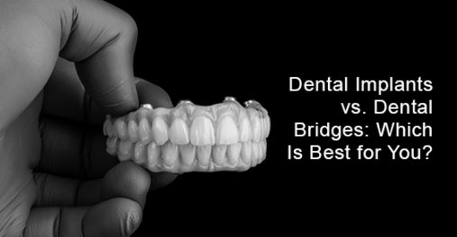 Dental implants vs. Dental bridges