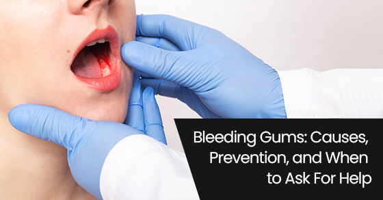 Bleeding gums: Causes, prevention, and when to ask for help